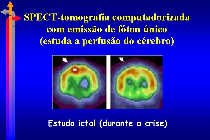 SPECT-tomografia computadorizada com emissão de fóton único (estuda a perfusão do cérebro) Estudo ictal