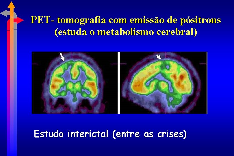 PET- tomografia com emissão de pósitrons (estuda o metabolismo cerebral) Estudo interictal (entre as