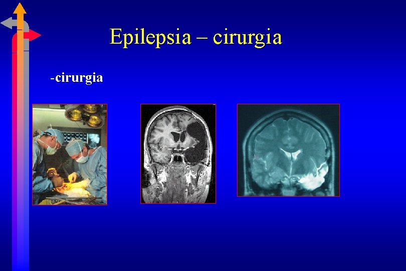 Epilepsia – cirurgia -cirurgia 