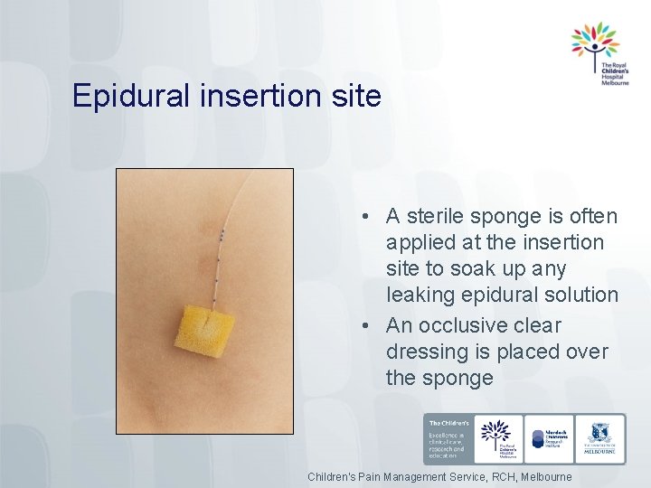 Epidural insertion site • A sterile sponge is often applied at the insertion site