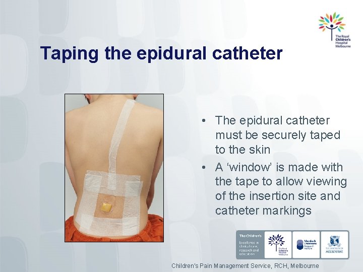 Taping the epidural catheter • The epidural catheter must be securely taped to the