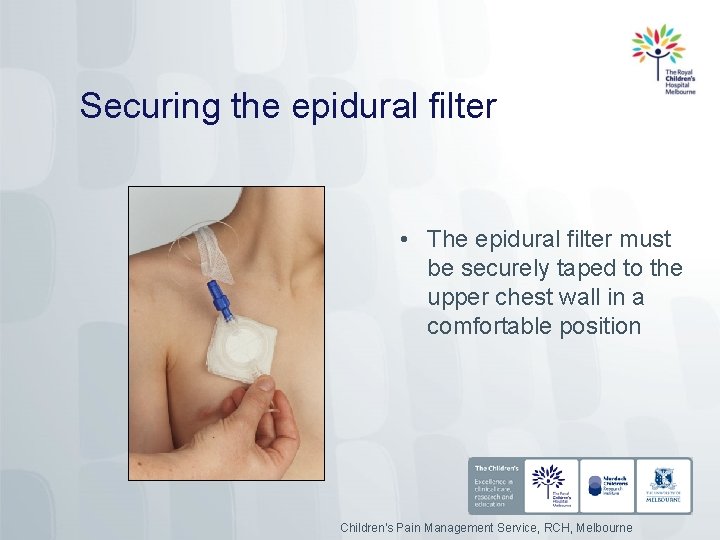 Securing the epidural filter • The epidural filter must be securely taped to the