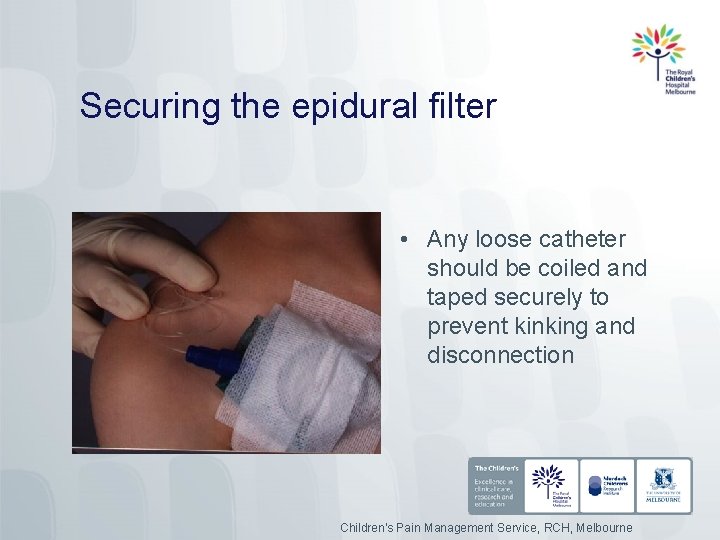 Securing the epidural filter • Any loose catheter should be coiled and taped securely