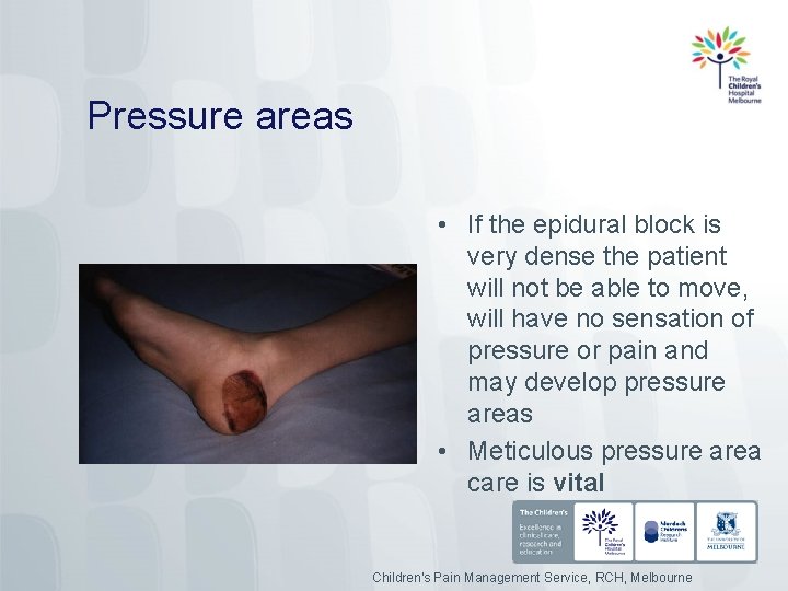 Pressure areas • If the epidural block is very dense the patient will not