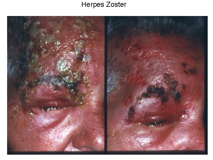 Herpes Zoster 