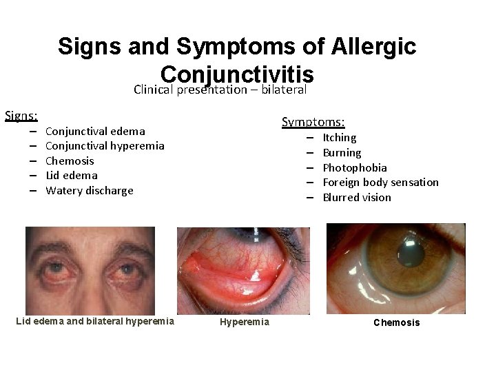 Signs and Symptoms of Allergic Conjunctivitis Clinical presentation – bilateral Signs: – – –