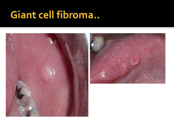 Giant cell fibroma. . 