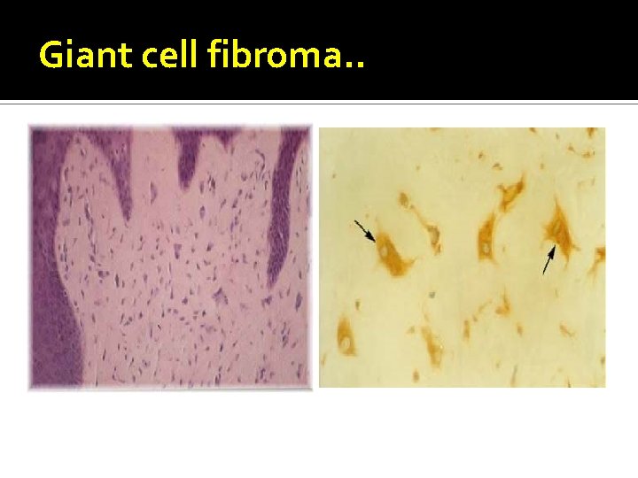 Giant cell fibroma. . 