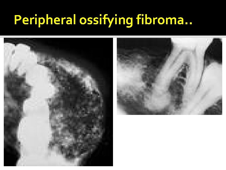 Peripheral ossifying fibroma. . 
