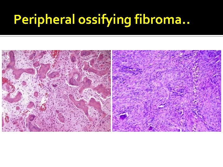 Peripheral ossifying fibroma. . 