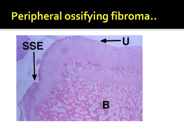 Peripheral ossifying fibroma. . 