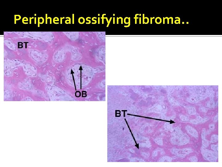 Peripheral ossifying fibroma. . 