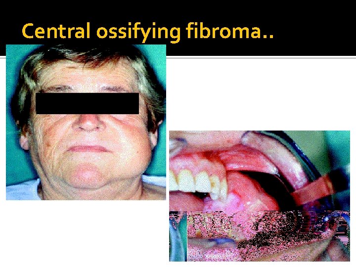 Central ossifying fibroma. . 