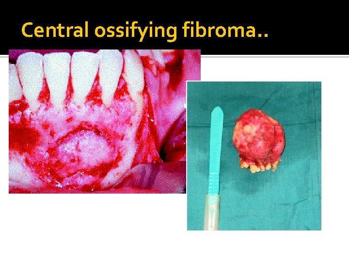 Central ossifying fibroma. . 