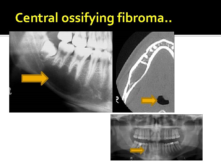 Central ossifying fibroma. . 