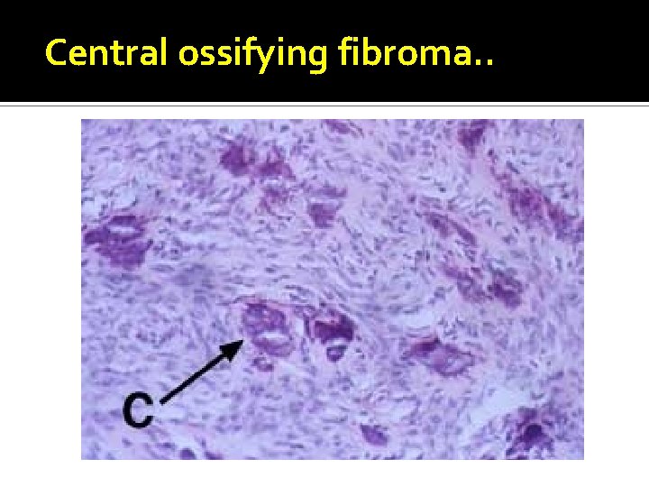 Central ossifying fibroma. . 