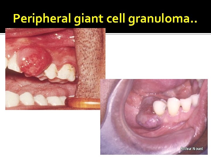 Peripheral giant cell granuloma. . 