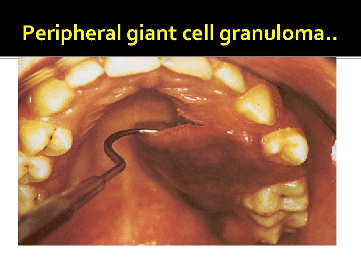 Peripheral giant cell granuloma. . 