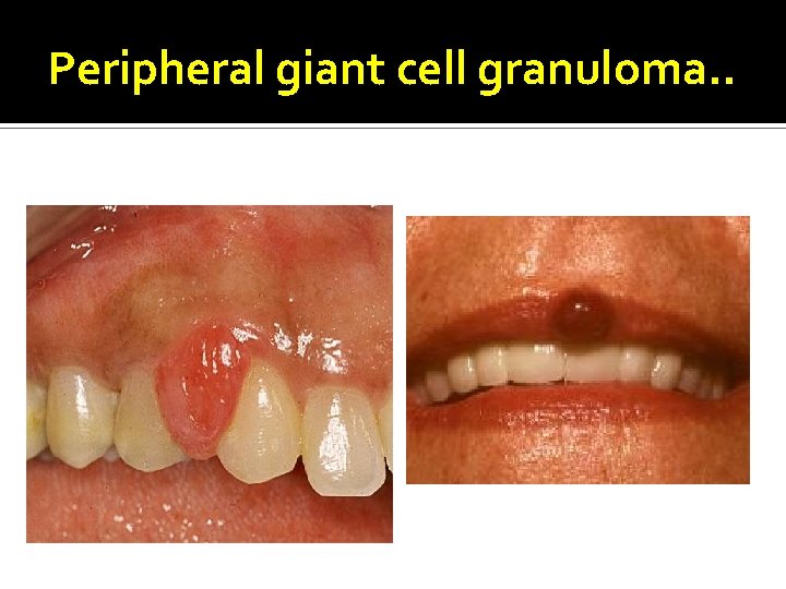 Peripheral giant cell granuloma. . 