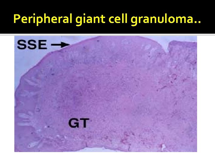 Peripheral giant cell granuloma. . 