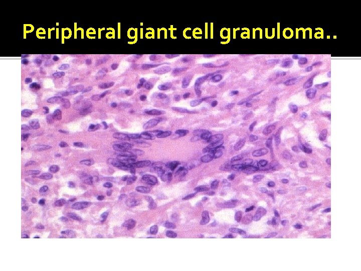 Peripheral giant cell granuloma. . 