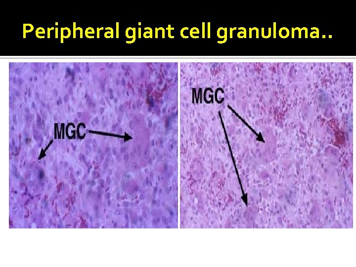 Peripheral giant cell granuloma. . 