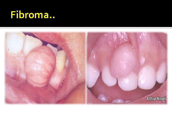 Fibroma. . 
