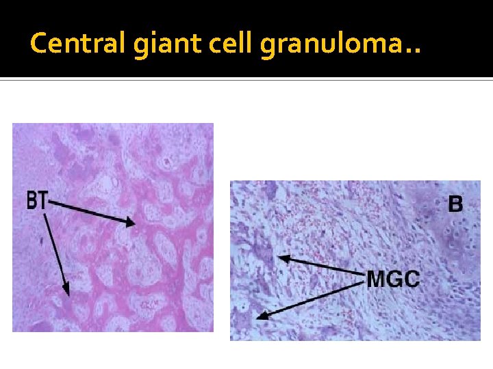 Central giant cell granuloma. . 