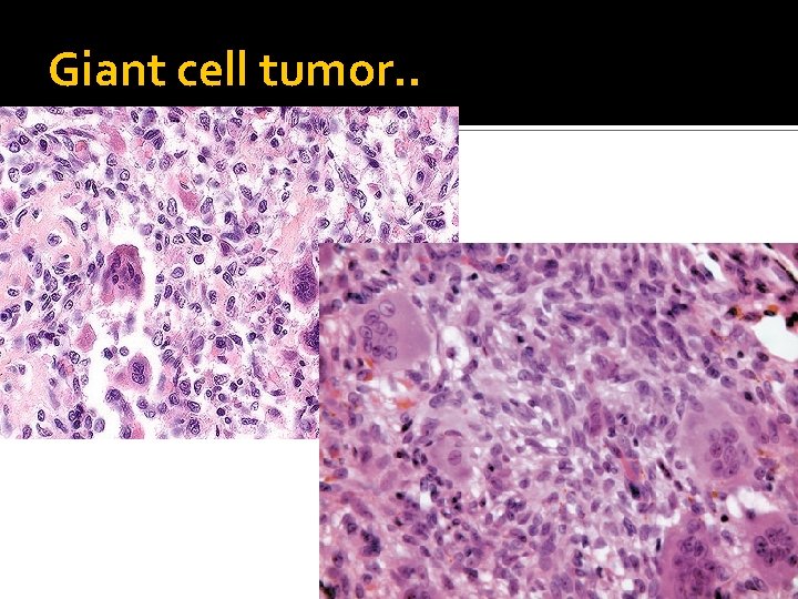 Giant cell tumor. . 