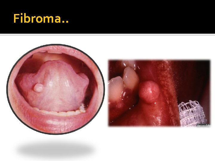 Fibroma. . 