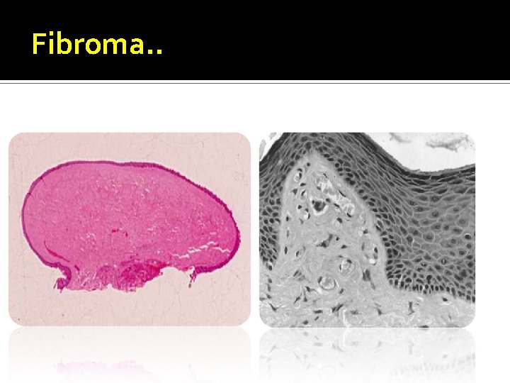 Fibroma. . 
