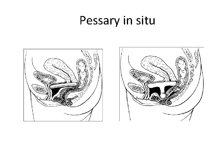  Pessary in situ 