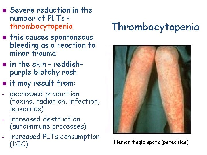n n - - Severe reduction in the number of PLTs thrombocytopenia this causes