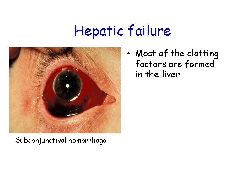 Hepatic failure • Most of the clotting factors are formed in the liver Subconjunctival