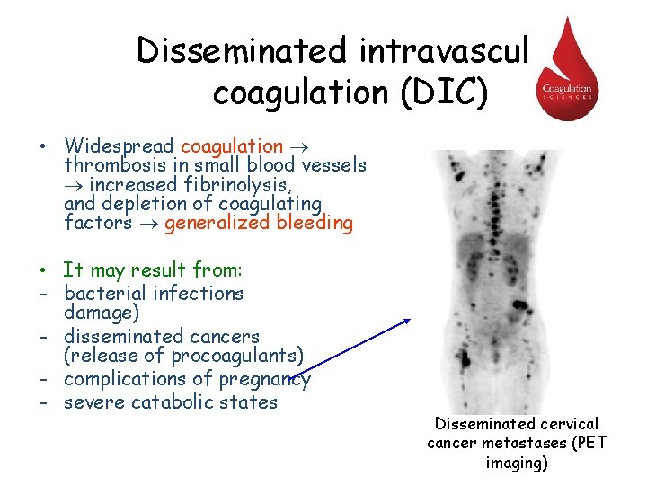 Disseminated intravascular coagulation (DIC) • Widespread coagulation thrombosis in small blood vessels increased fibrinolysis,