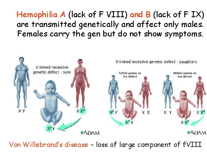 Hemophilia A (lack of F VIII) and B (lack of F IX) are transmitted