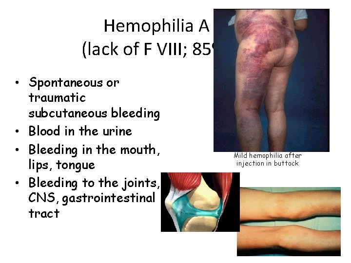 Hemophilia A (lack of F VIII; 85%) • Spontaneous or traumatic subcutaneous bleeding •