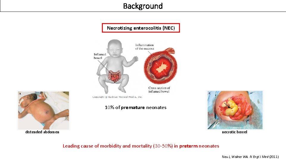 Background Necrotizing enterocolitis (NEC) 10% of premature neonates distended abdomen necrotic bowel Leading cause