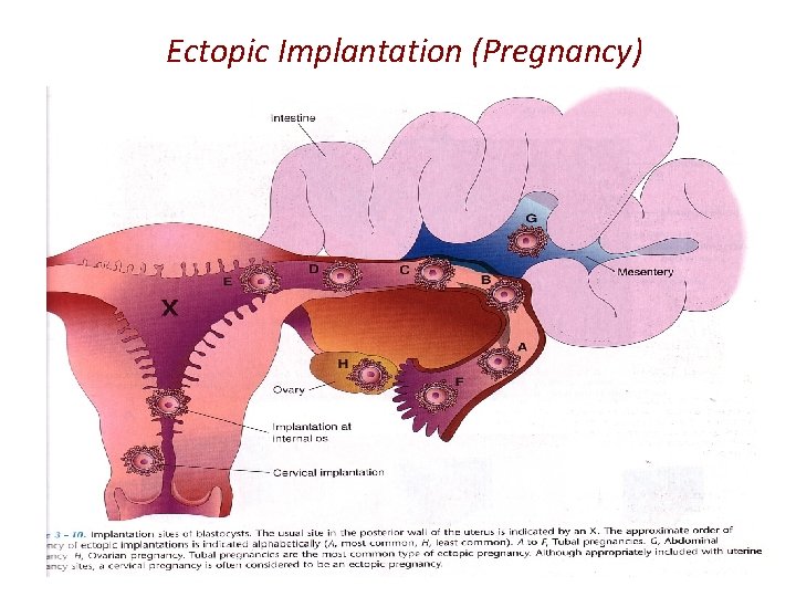 Ectopic Implantation (Pregnancy) 