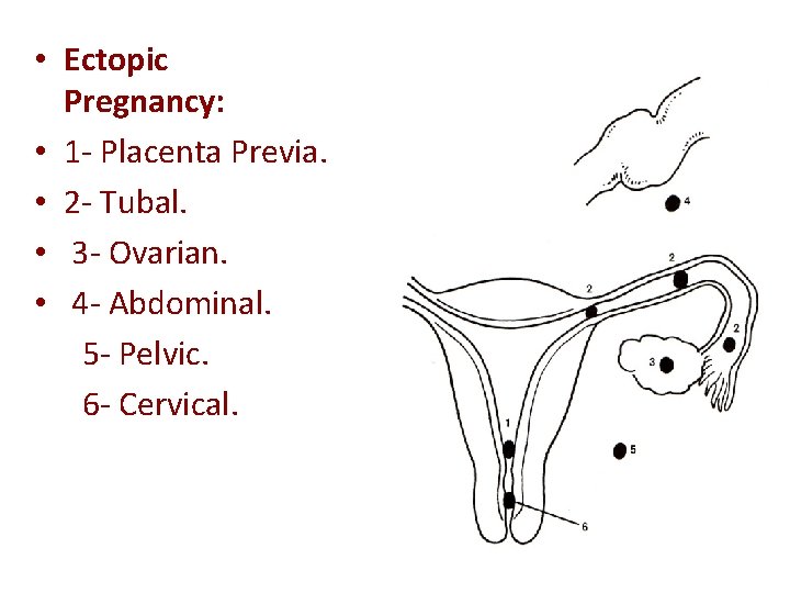  • Ectopic Pregnancy: • 1 - Placenta Previa. • 2 - Tubal. •