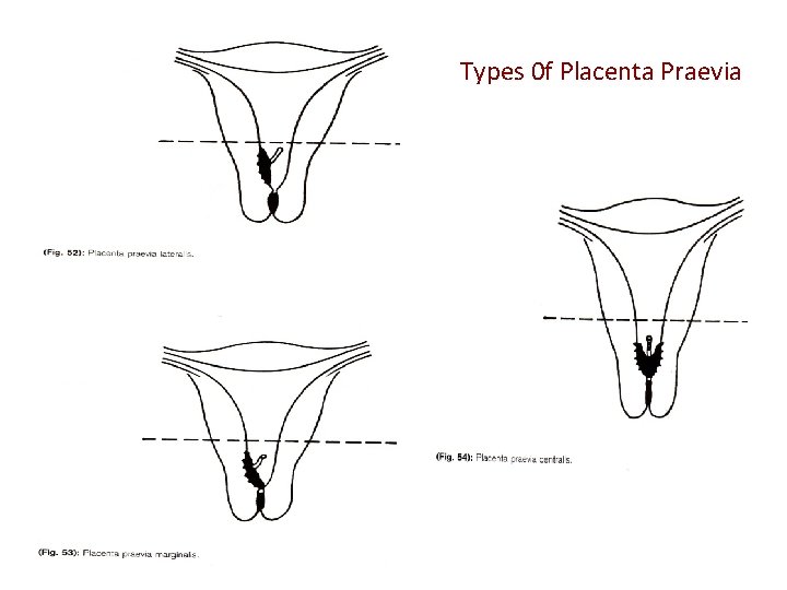 Types 0 f Placenta Praevia 