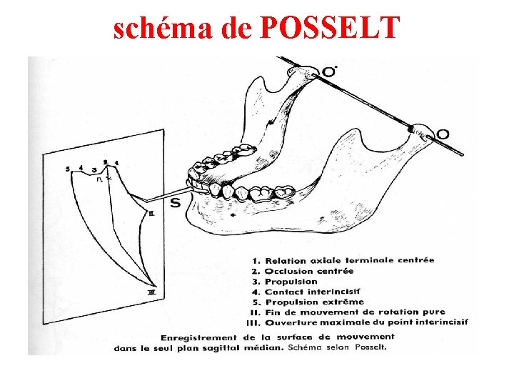 schéma de POSSELT 