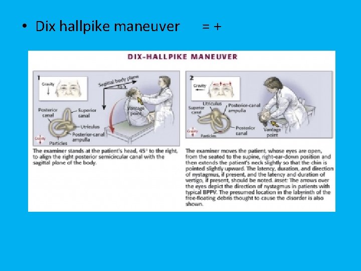  • Dix hallpike maneuver = + 