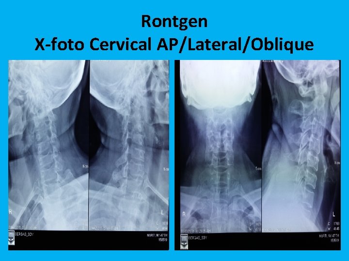 Rontgen X-foto Cervical AP/Lateral/Oblique 