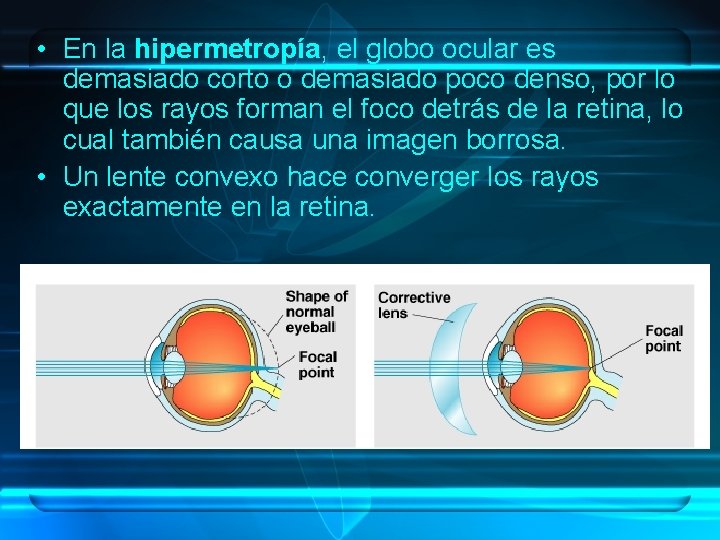  • En la hipermetropía, el globo ocular es demasiado corto o demasiado poco