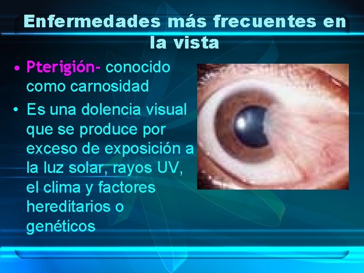 Enfermedades más frecuentes en la vista • Pterigión- conocido como carnosidad • Es una