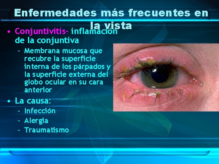 Enfermedades más frecuentes en la vista • Conjuntivitis- inflamación de la conjuntiva – Membrana