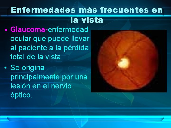 Enfermedades más frecuentes en la vista • Glaucoma-enfermedad ocular que puede llevar al paciente