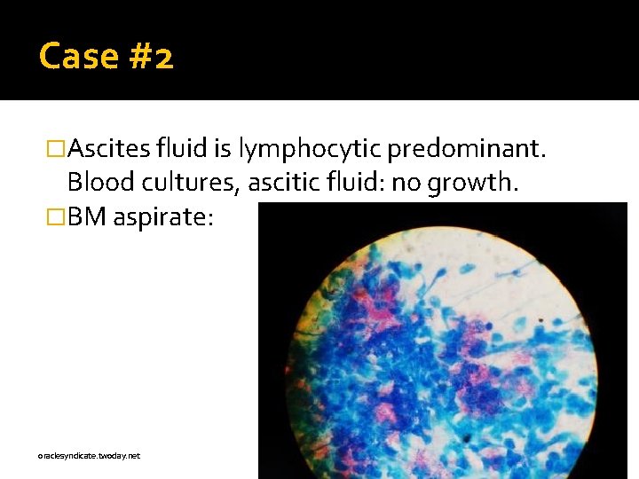 Case #2 �Ascites fluid is lymphocytic predominant. Blood cultures, ascitic fluid: no growth. �BM