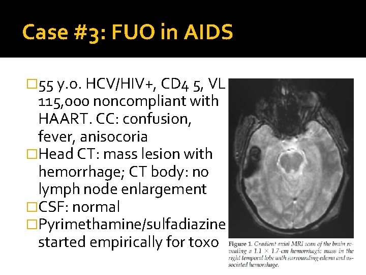 Case #3: FUO in AIDS � 55 y. o. HCV/HIV+, CD 4 5, VL